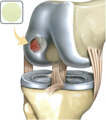 아티필름연골재생술이란, 기존 연골재생술은 연골이 자라는데 한계가 있습니다. 아티필름이란 신기술 배양필름을 이용해 생체피막을 입힘으로써 효과적인 연골재생에 좋은 보조역할을 할 수 있습니다.